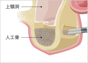 サイナスリフト（上顎洞底挙上術）