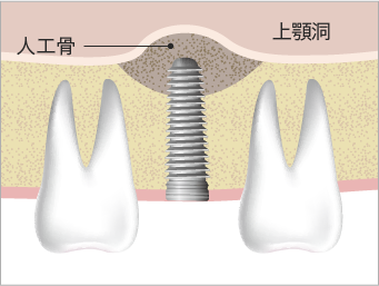 ソケットリフト（上顎洞底挙上術）