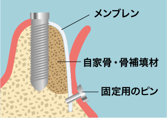 骨移植（ボーンクラフト）