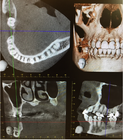 歯科用CT